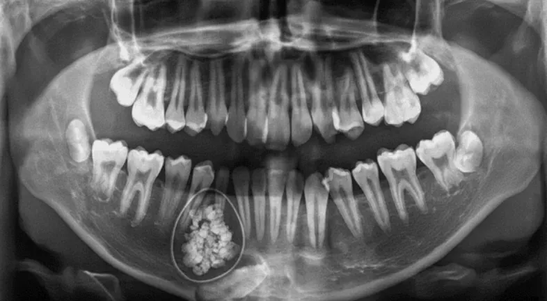 X-ray showing Odontoma