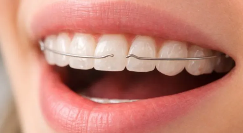 Close-up of a person’s mouth showing a broken retainer wire