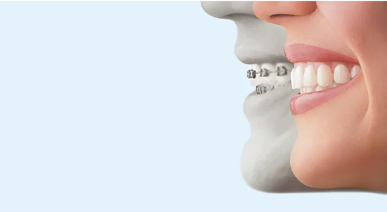 A side-by-side comparison of aligners vs braces 