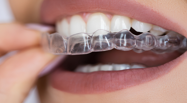 A close-up of a girl applying clear aligners.