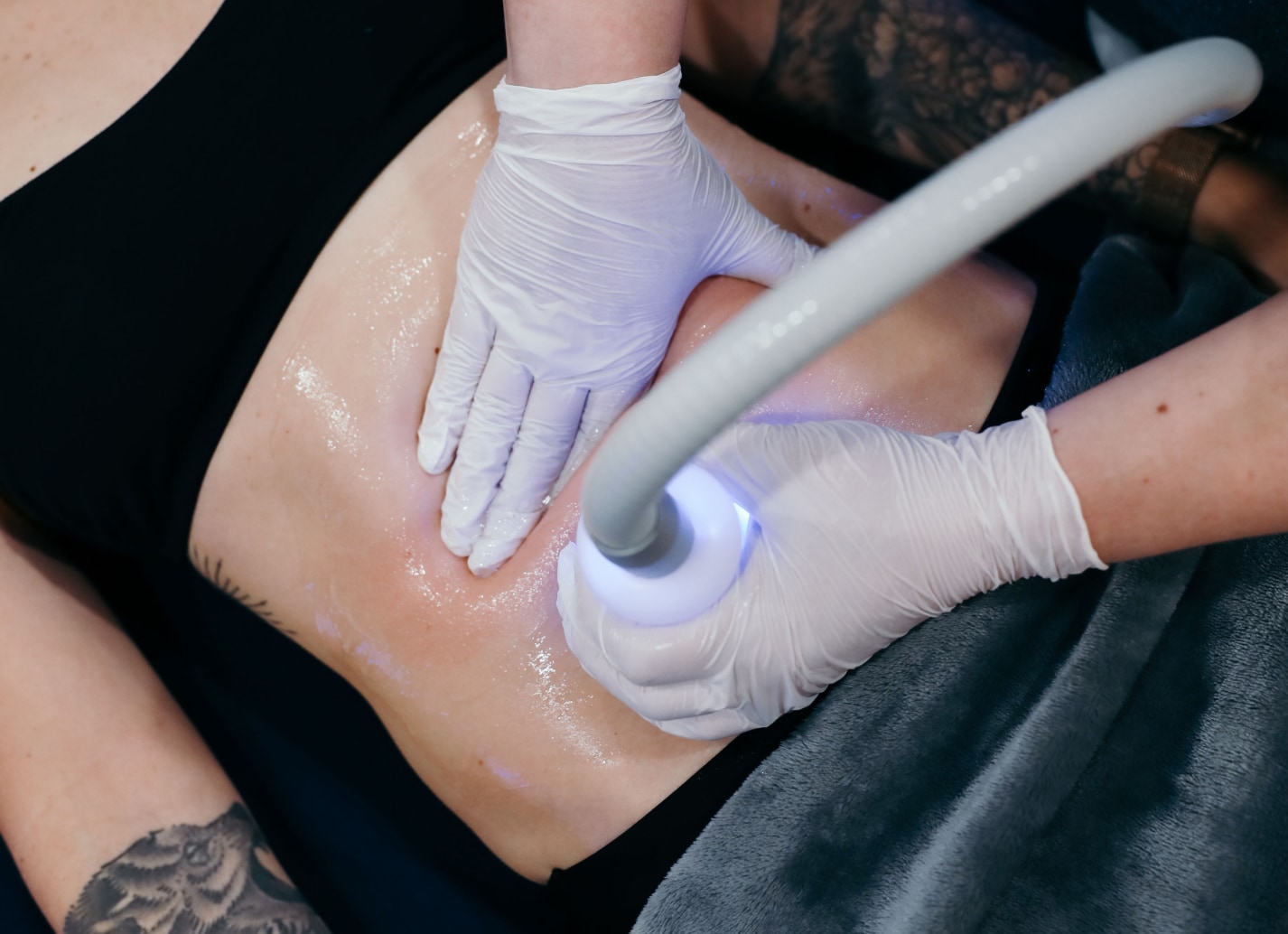 Woman receiving cryoskin treatment on stomach.