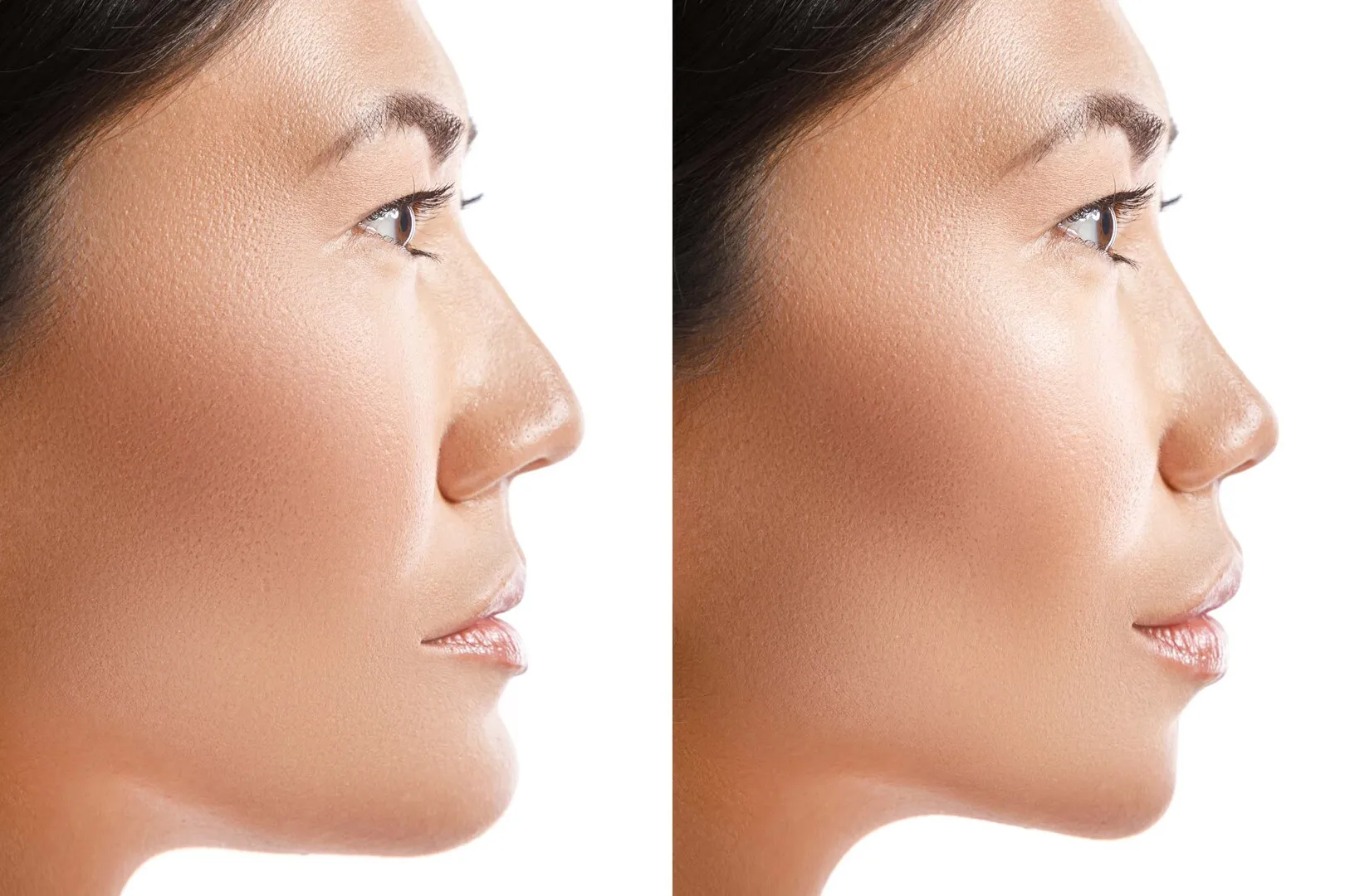 Orthognathic Surgery in Monterey, CA