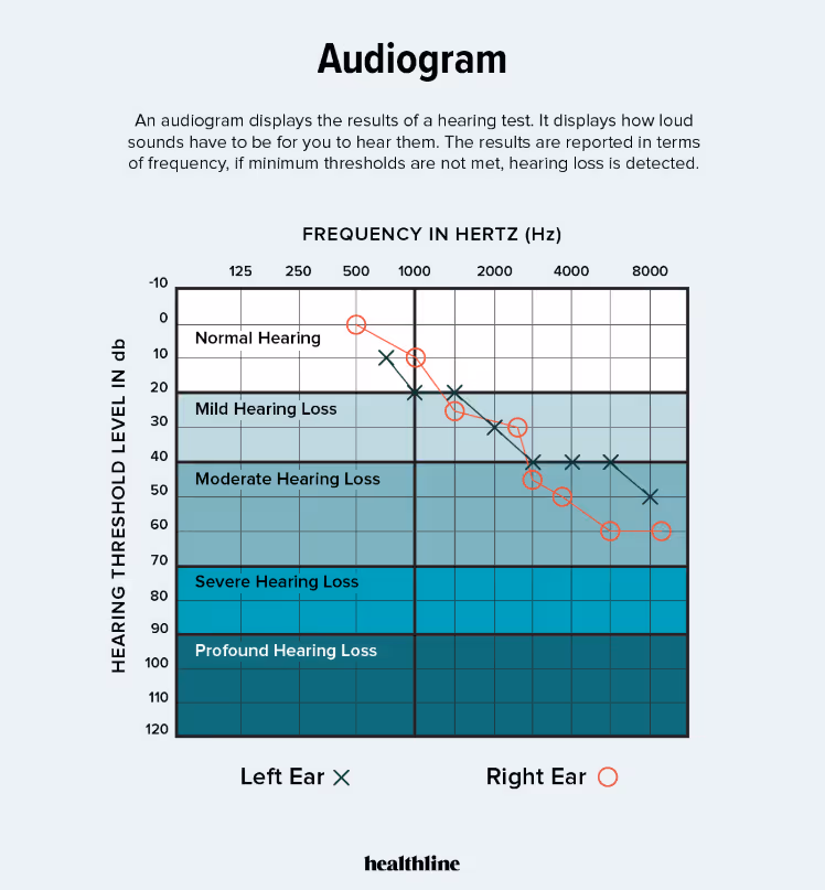 An audiogram chart showing degrees of hearing loss plotted against sound frequency and decibel levels. The graph includes categories such as normal, mild, moderate, severe, and profound hearing loss, with left and right ear hearing results marked by symbols.