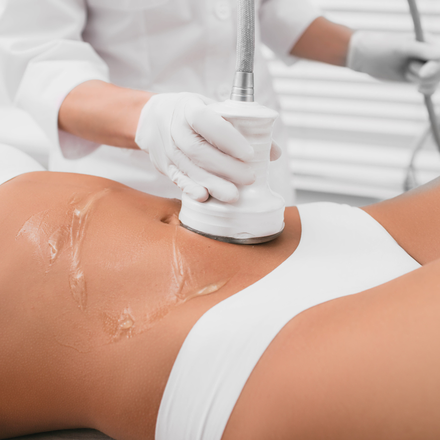 Cavitación en Tandil, centro de estética 