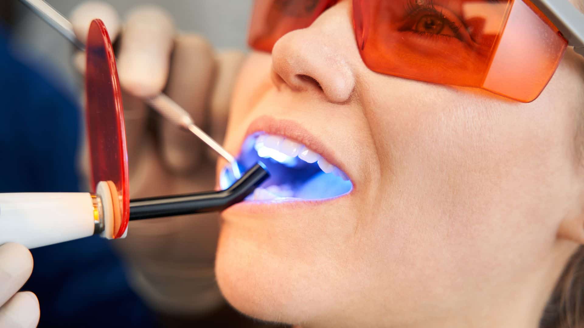 Someone getting dental fillings in London