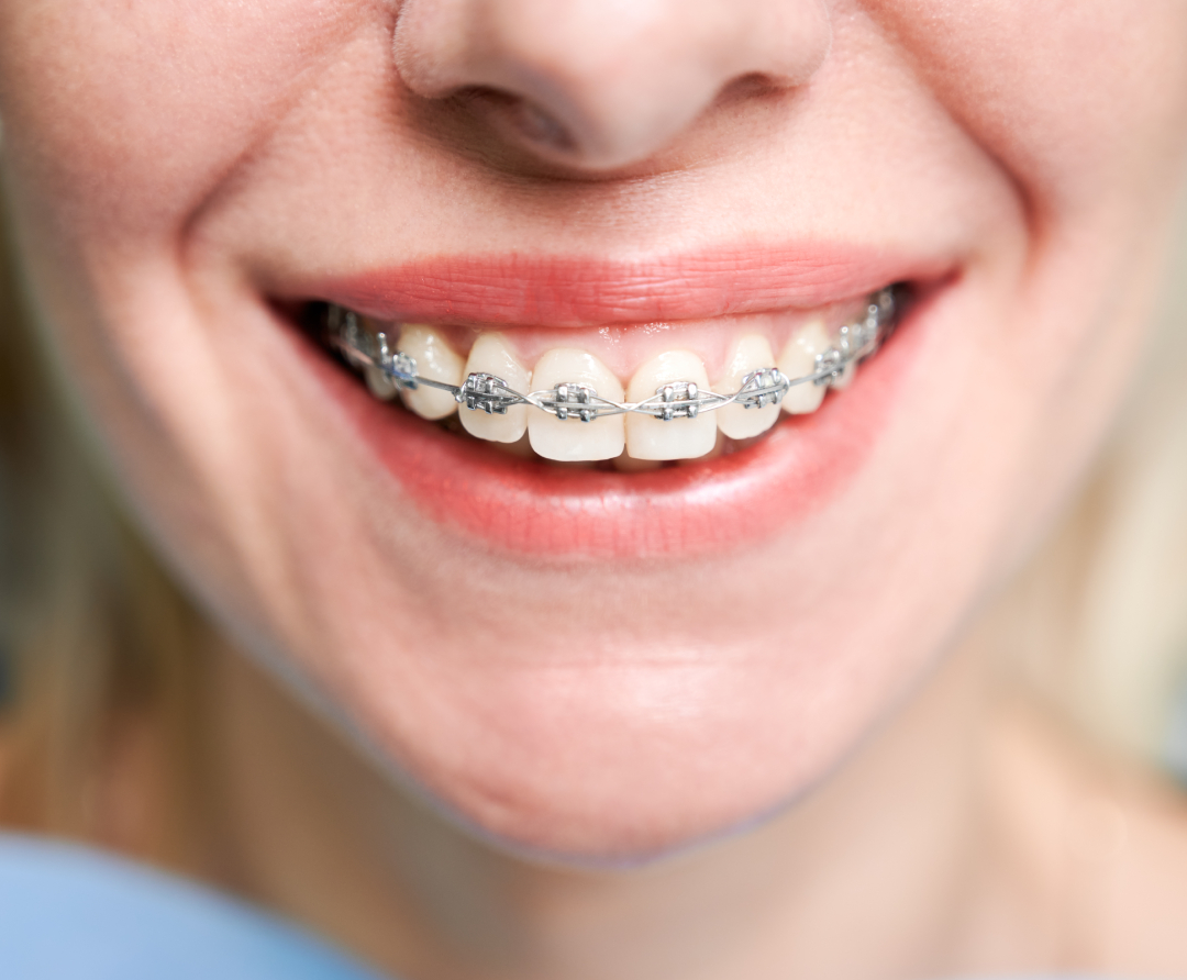 Benefits of Fixed Braces at Notting Hill