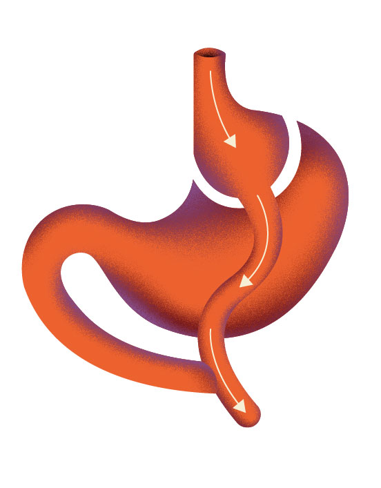 Illustration zur Funktionsweise der Magenverkleinerung