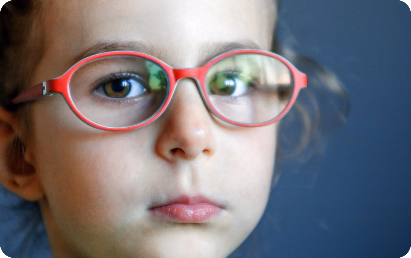 Photo of girl with lazy eye/amblyopia