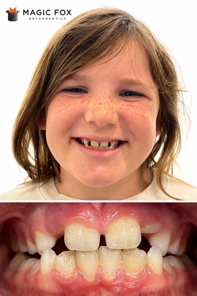 Patient 6 smile before orthodontic treatment