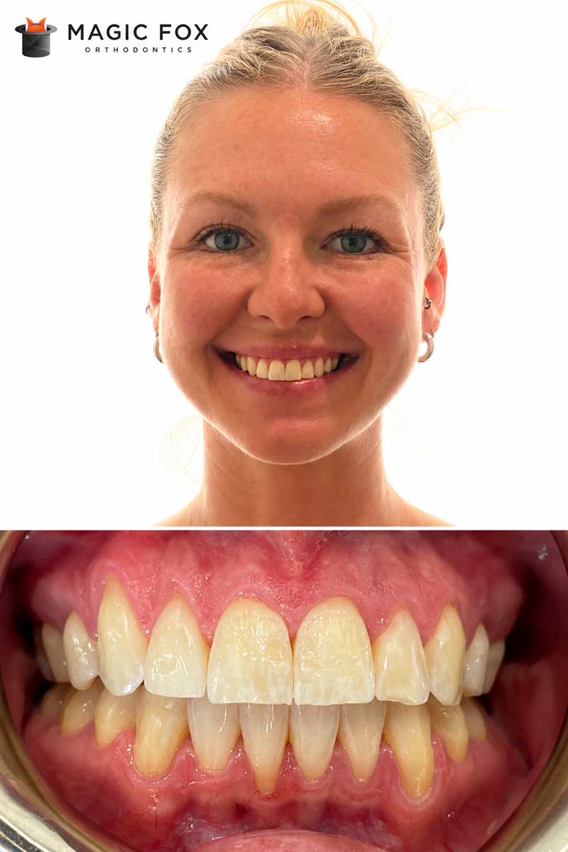 Patient 1 smile after orthodontic treatment at Magic Fox Orthodontics