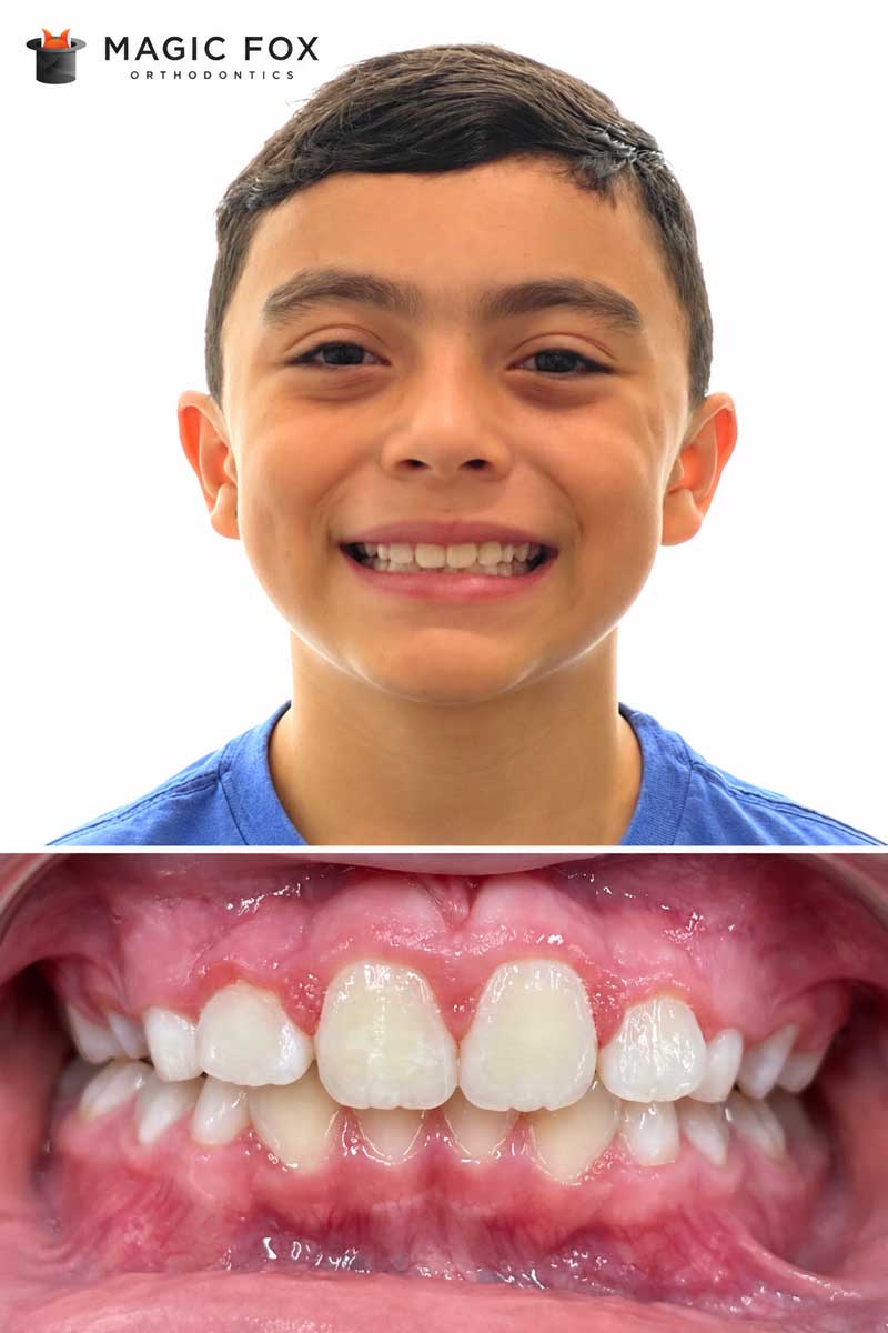 Patient 5 smile after orthodontic treatment at Magic Fox Orthodontics