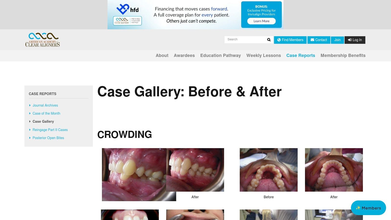 American Academy of Clear Aligners (AACA) — Professional Case Gallery