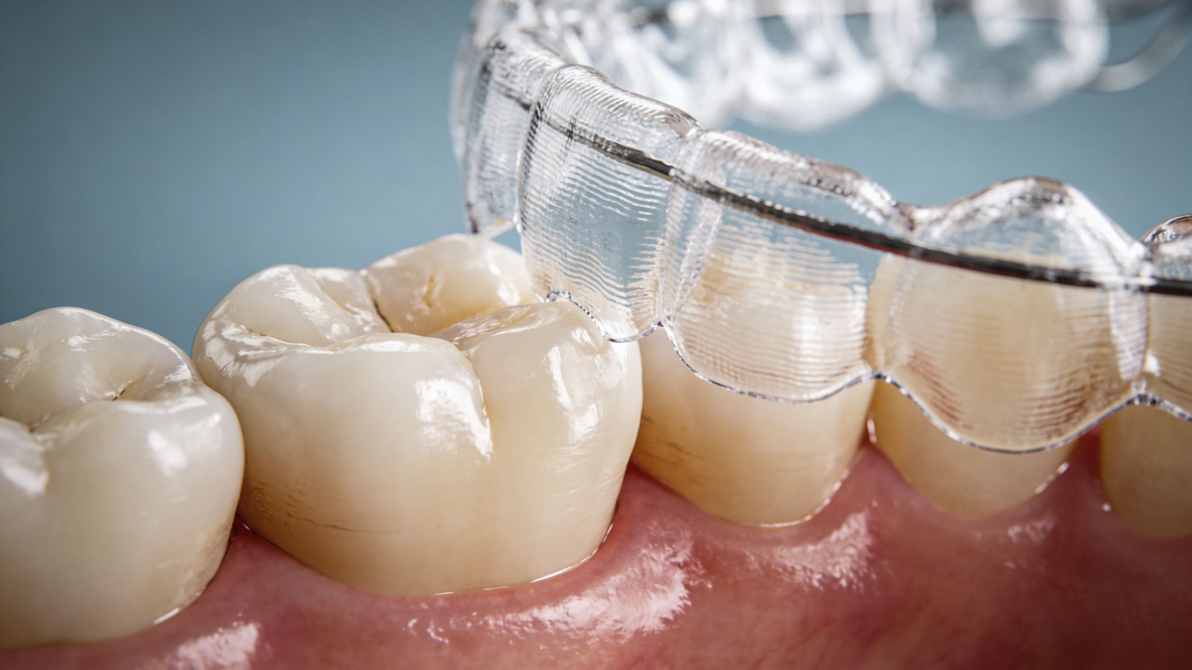 Close-up of human teeth with a clear plastic orthodontic aligner being fitted to straighten them.