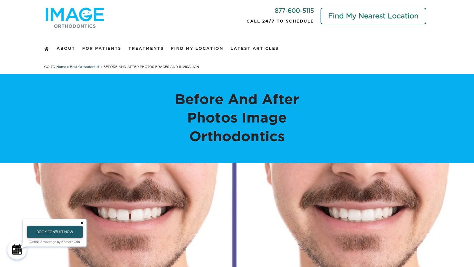 Image Orthodontics (San Francisco Bay Area) – Before & After Photos (Invisalign + Myofunctional therapy)