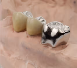 Metal Crowns - Parkway Smiles Dentistry