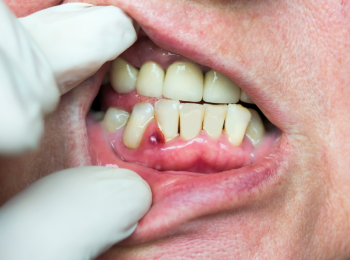FREE Invisalign® I Dr. Gujit S Randhawa