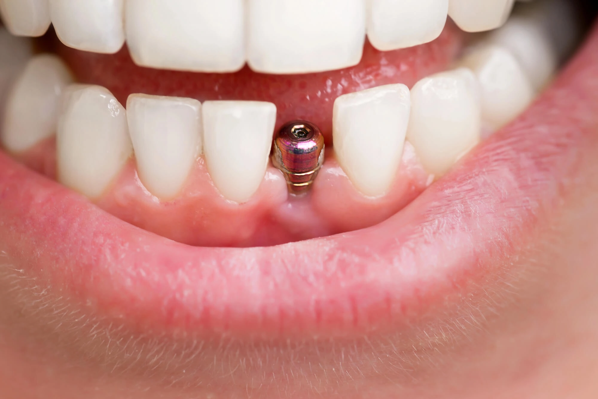 dental implants sterling va in patient's tooth