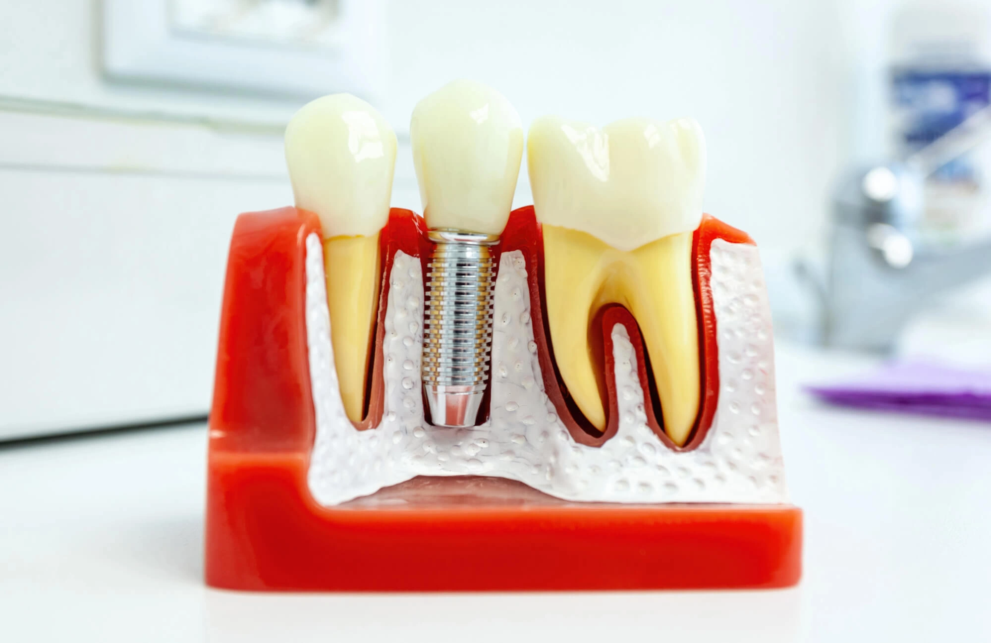 dental implants sterling va