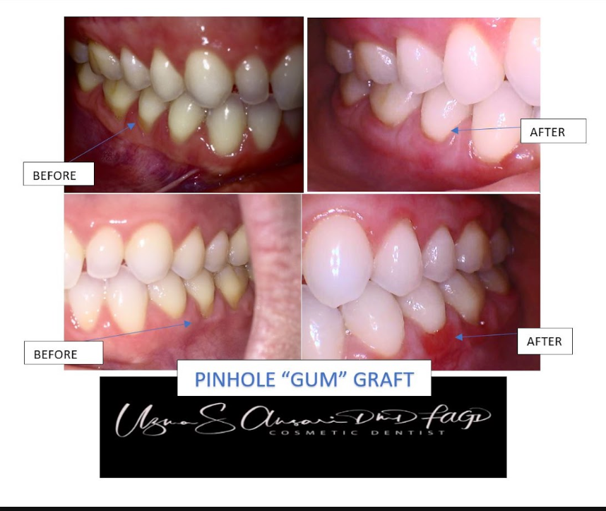 Chao Pinhole® Surgical Technique at Lowes Island Dentistry