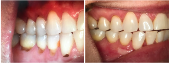Before and after Chao Pinhole® treatment at Lowes Island Dentistry