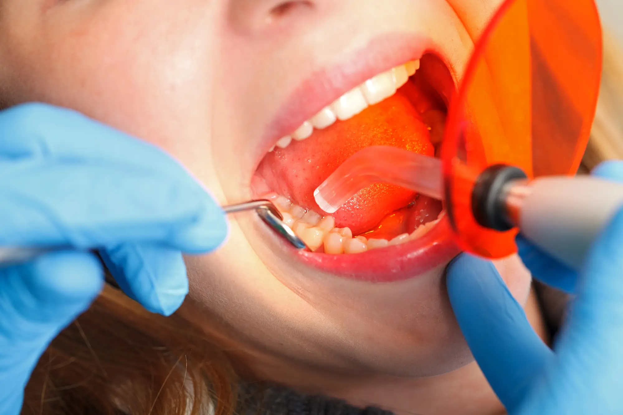 Dental Filling by Emergency Dentist in Lake Ridge VA