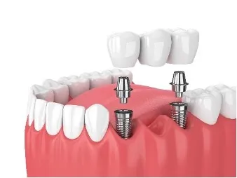 Mini Dental Implants