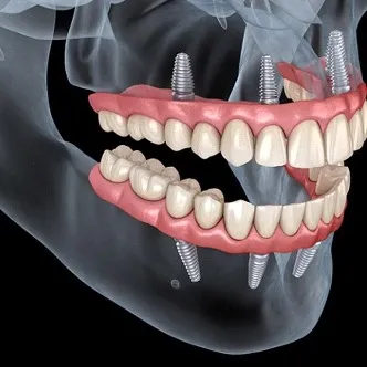 All-on-Four Dental Implants
