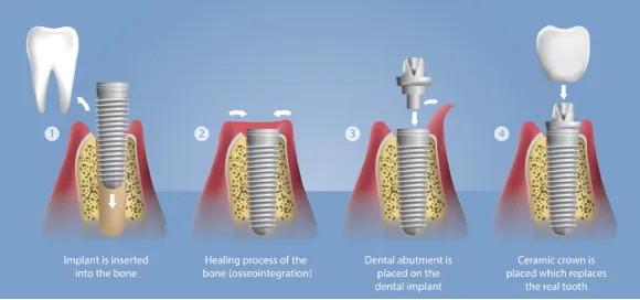 Dental Implant Process
