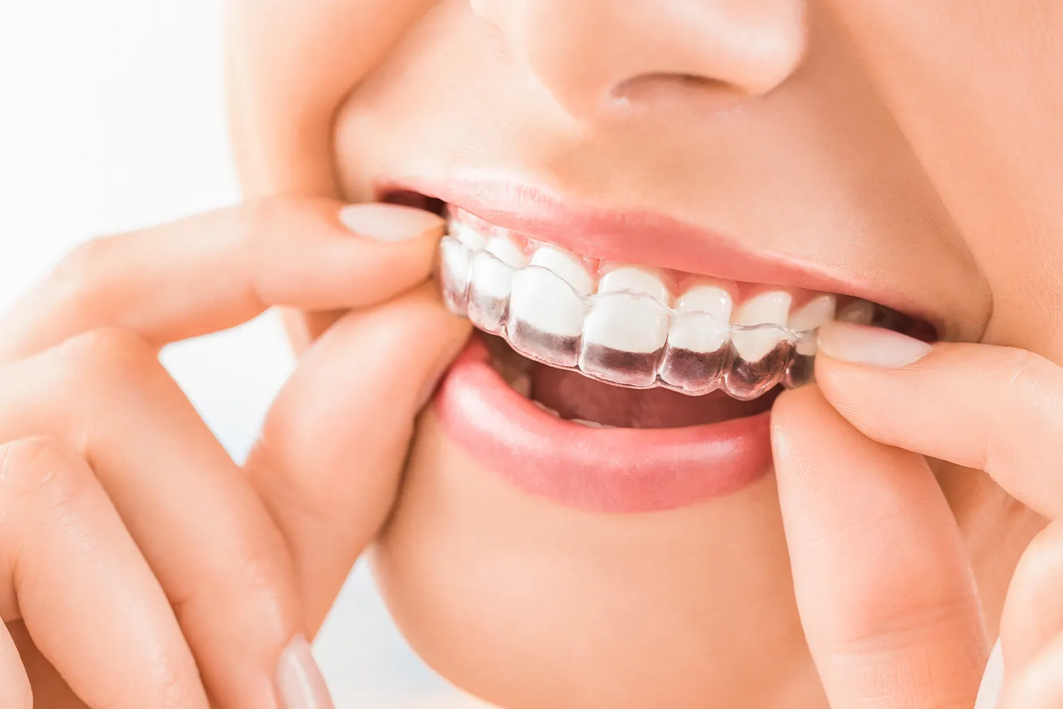 Invisalign in Falls Church | Tysons Dental Esthetics