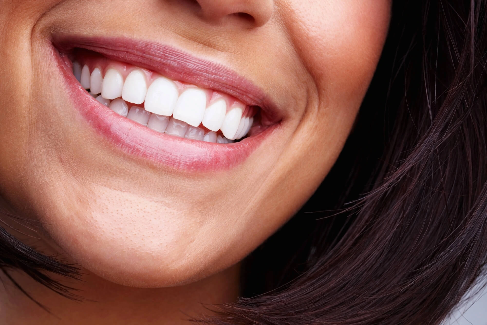 Veneers in Alexandria, VA | NaLa Smiles