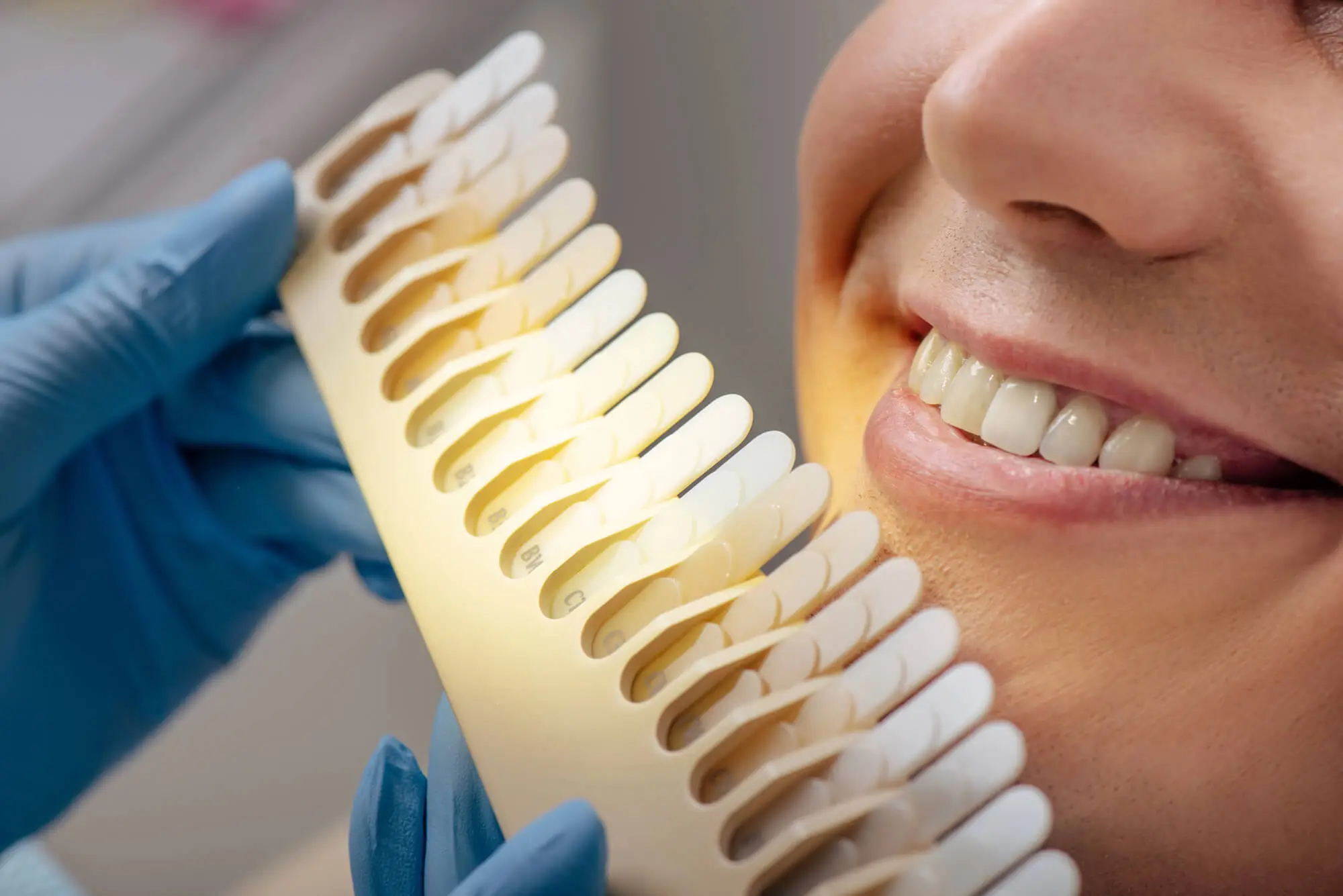 Teeth Whitening in Alexandria, VA | NaLa Smiles