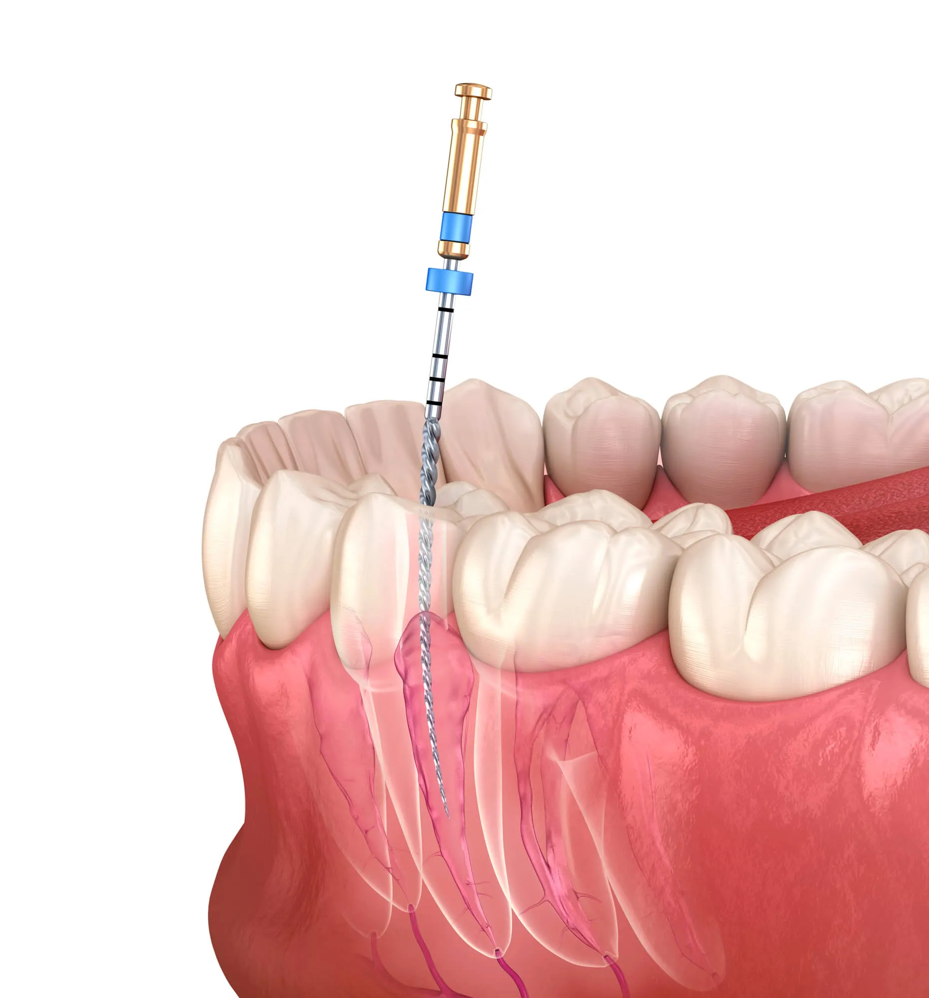Dentist on the Parkway root canal