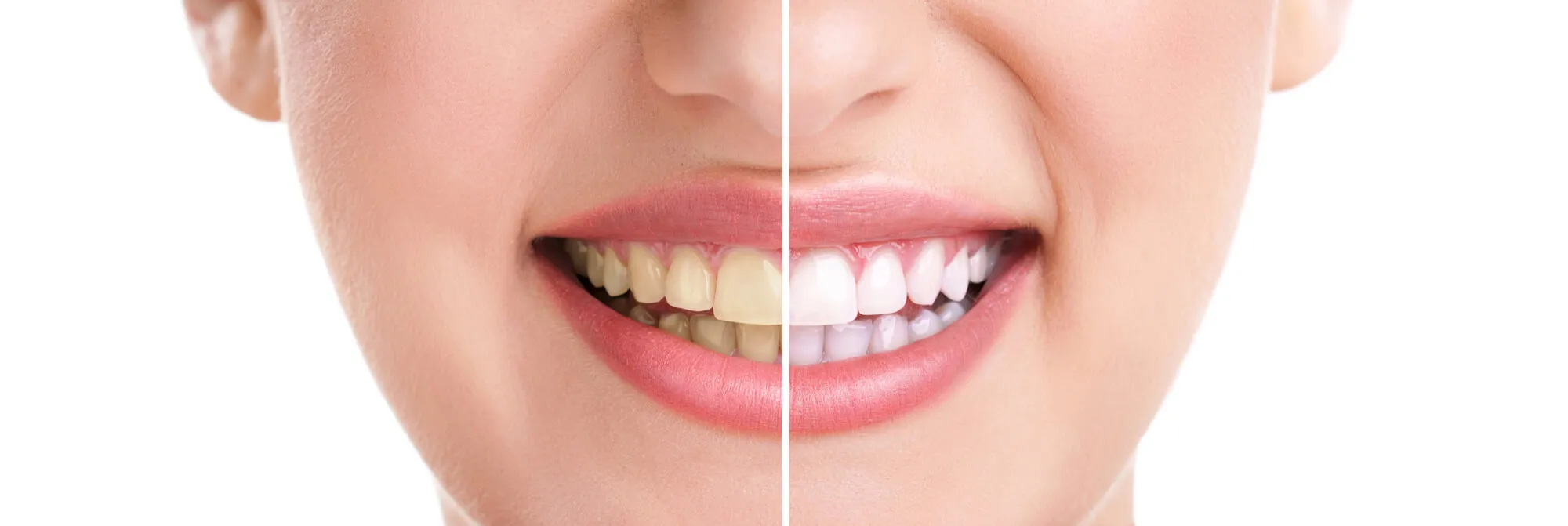 before and after teeth whitening alexandria va