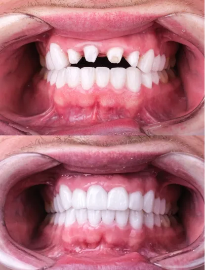 Before After Dental