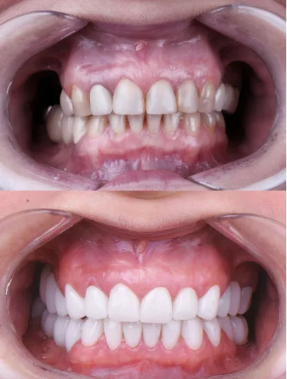 Before After Dental