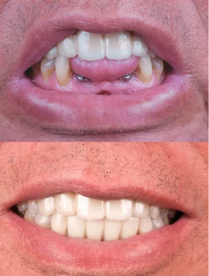 Before After Dental