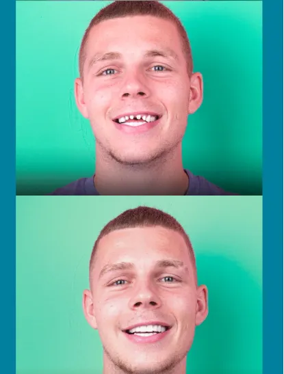 Before After Dental
