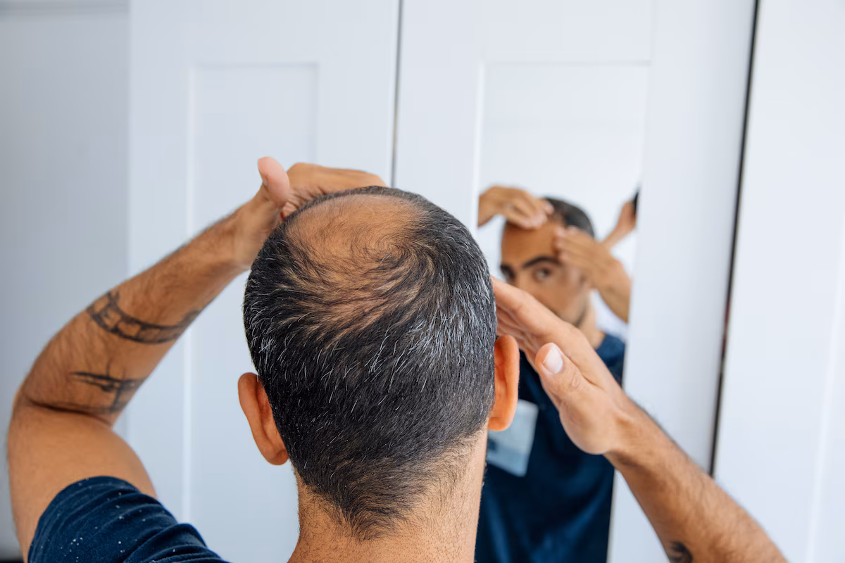 Algemeen Dagblad over haaruitval en finasteride | AD Fellos