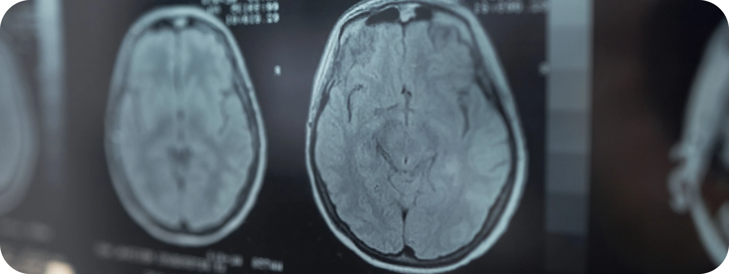 Brain MRI images displayed on a screen