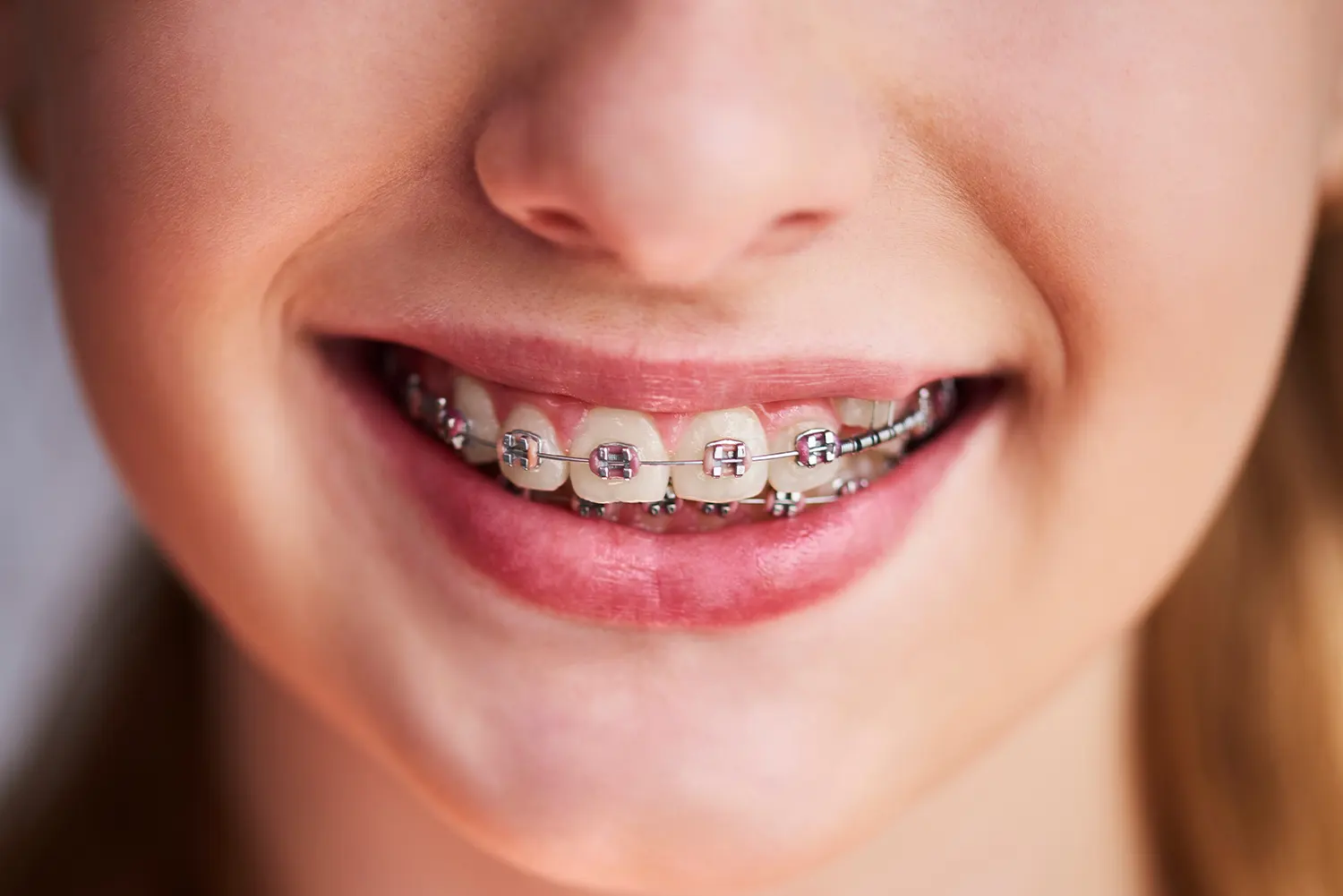 Braces in Grand Rapids