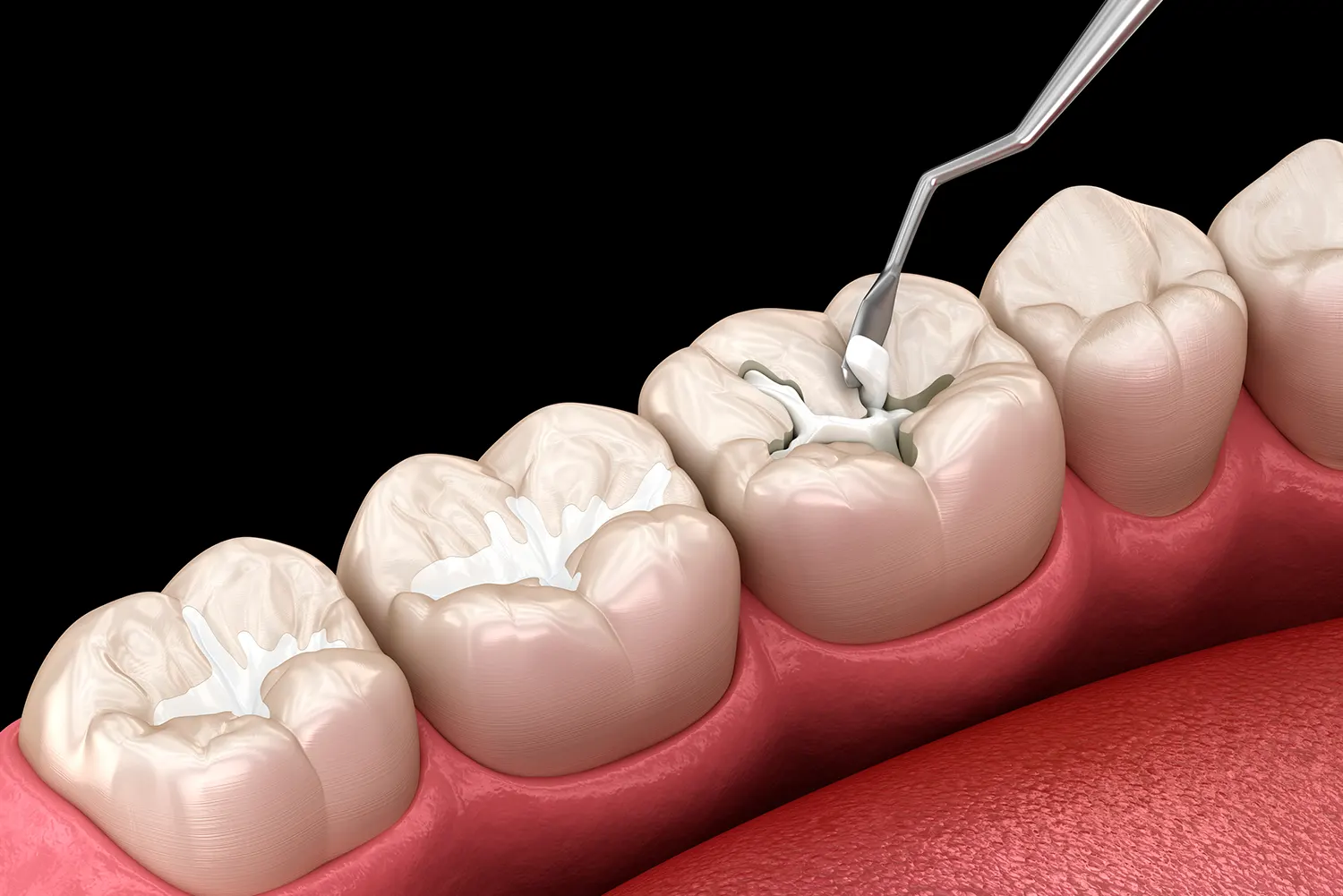 Pediatric Dental Sealants in Grand Rapids