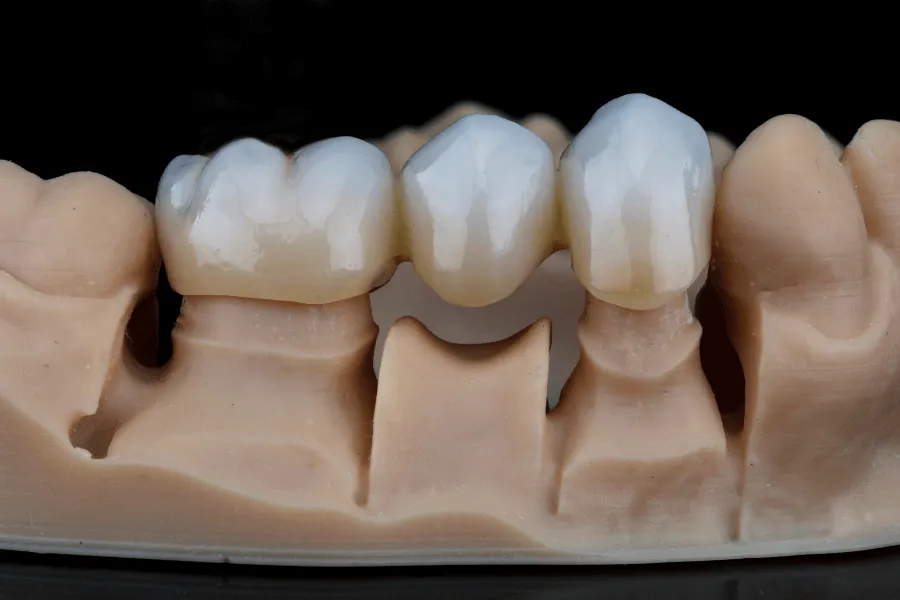 brak-zeba-most-protetyczny-czy-implant