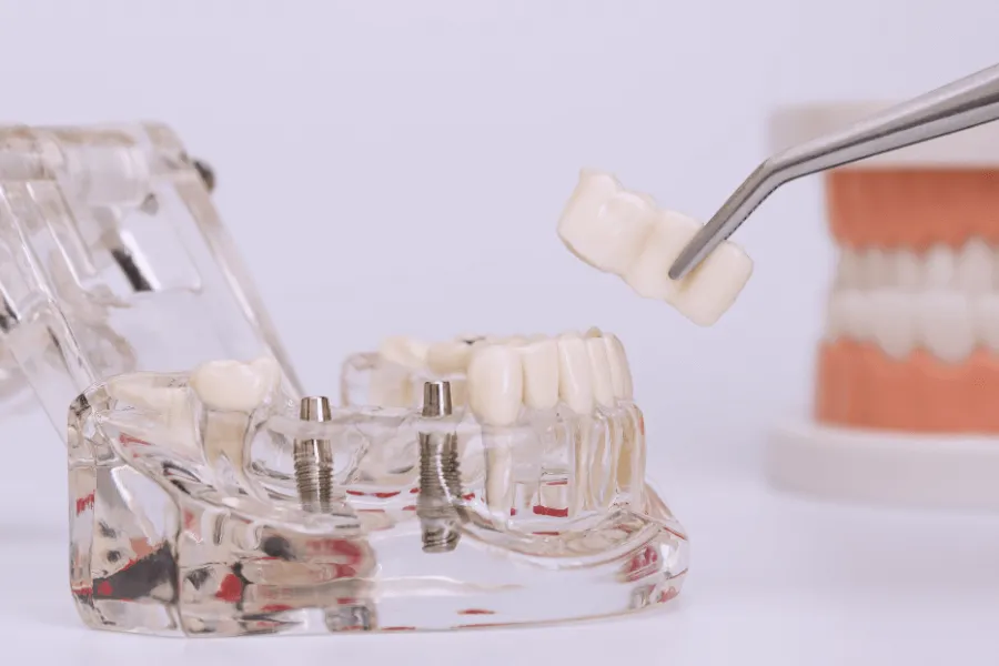 most-protetyczny-czy-implant-warszawa