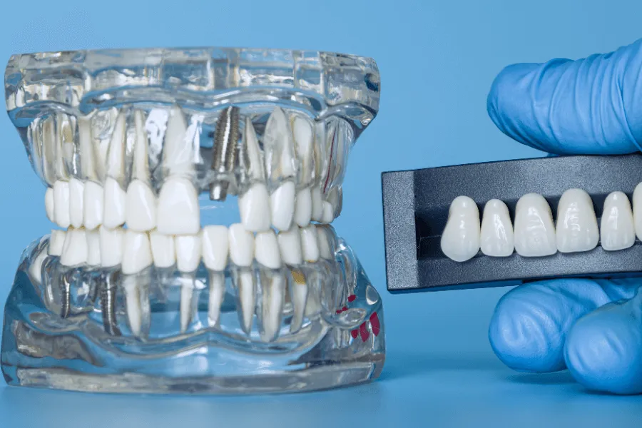 porownanie-mostu-protetycznego-i-implantu