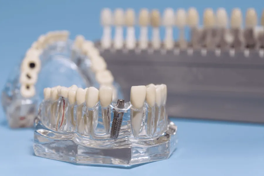 ile-kosztuje-implant-zebowy-warszawa