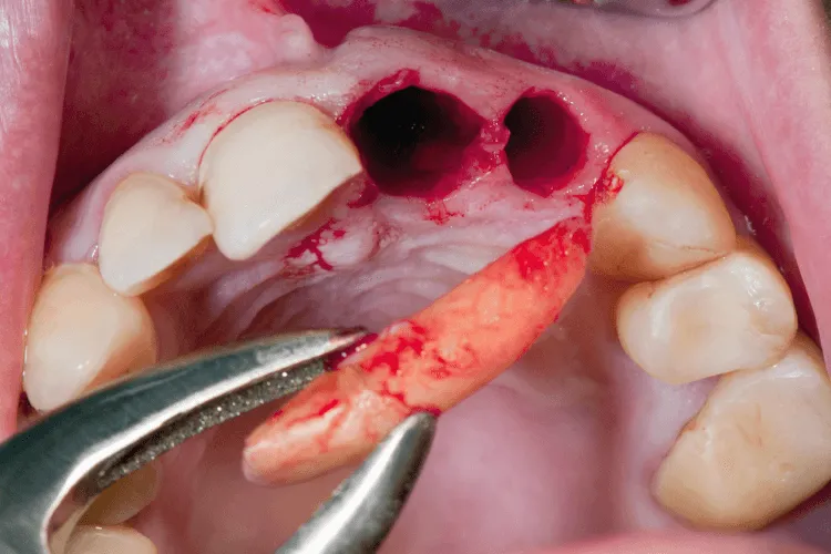suchy-zebodol-leczenie-w-gabinecie-stomatologicznym