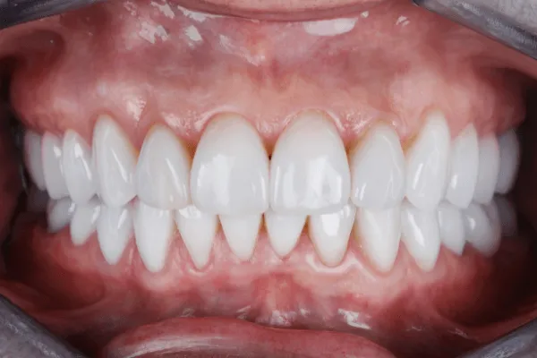 konturowanie-zebow-warszawa