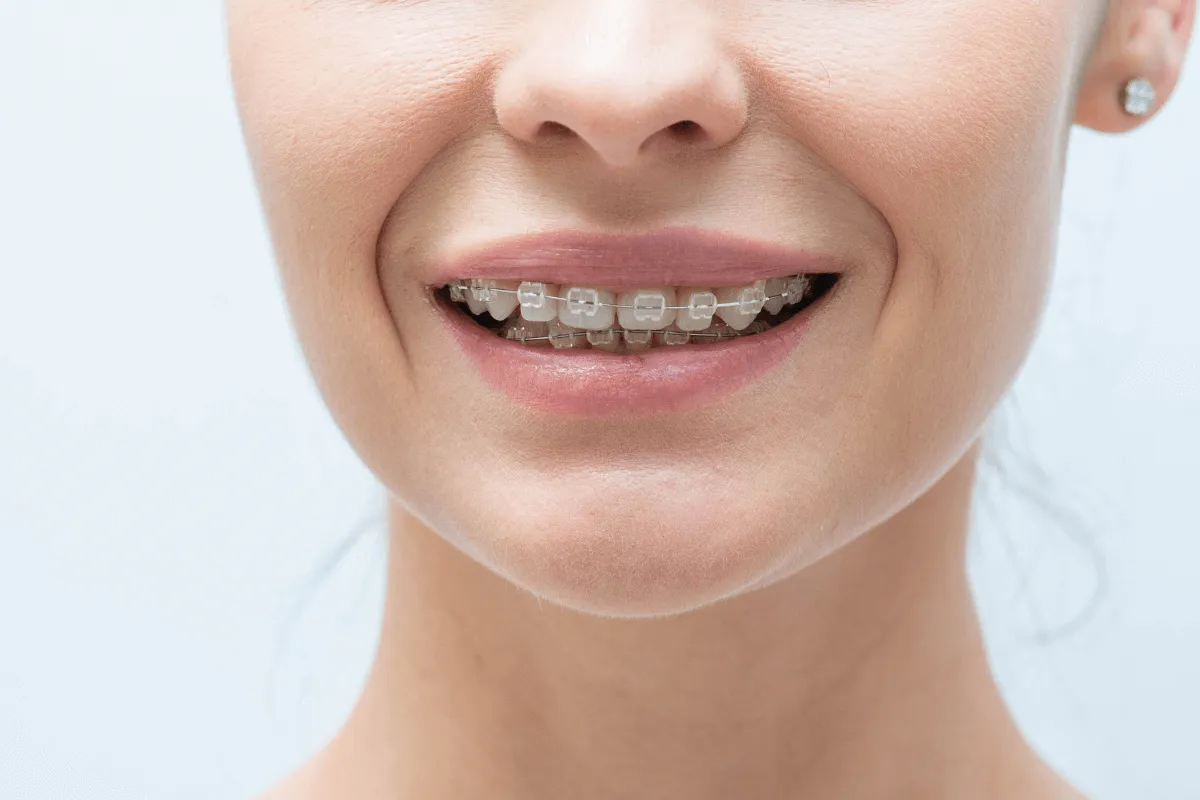 najczestsze-wady-zgryzu