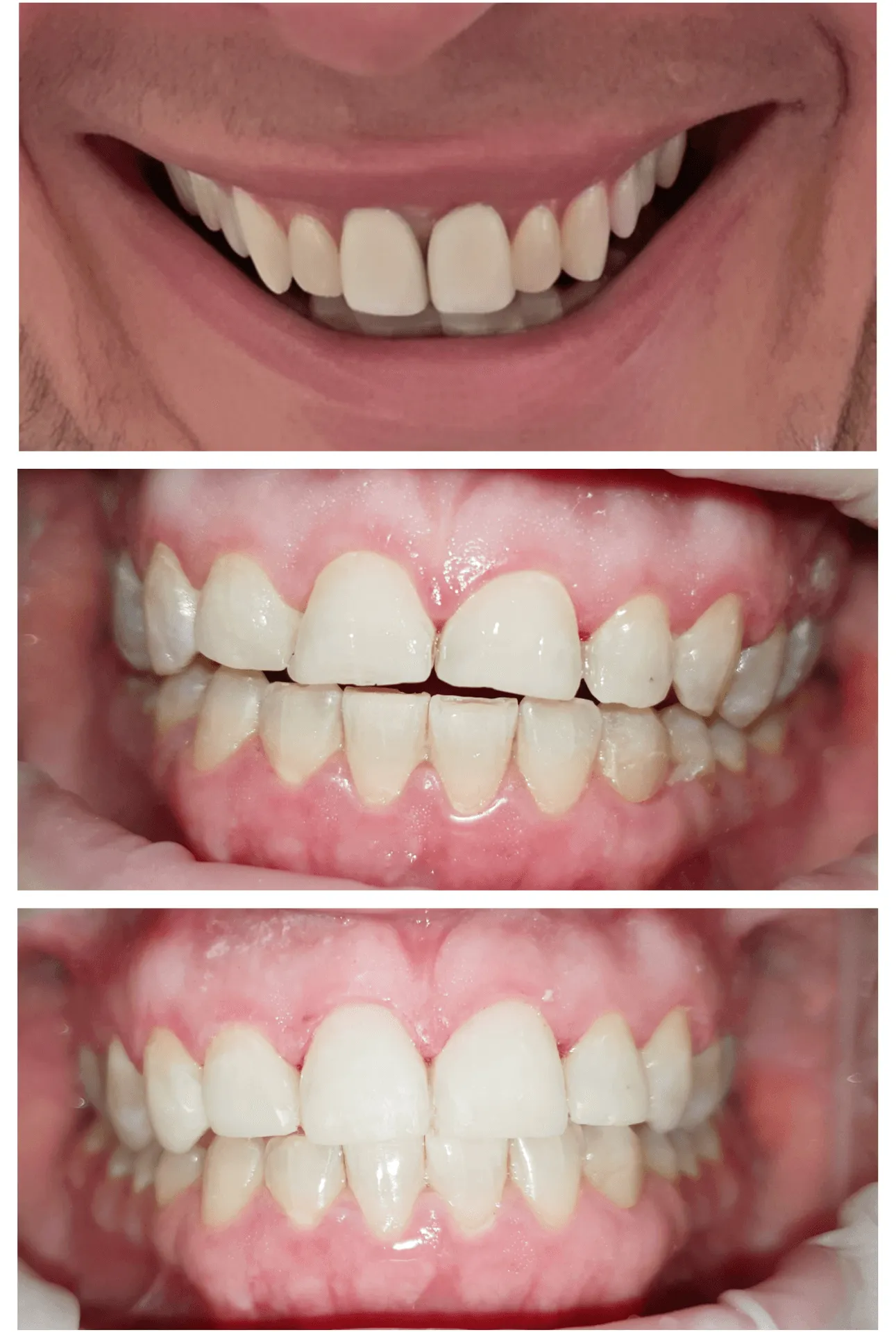 roznice-w-optyce-kompozytow