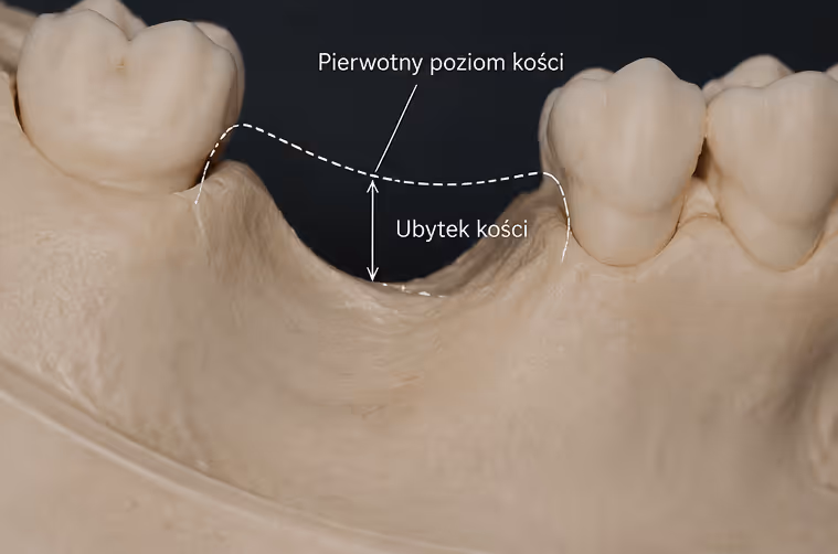Model anatomiczny ilustrujący ubytek kości w zębodole po ekstrakcji